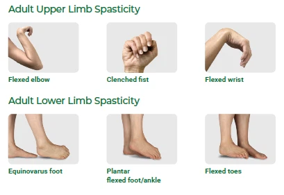 muscle spasticity