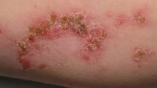treating acne or other skin conditions